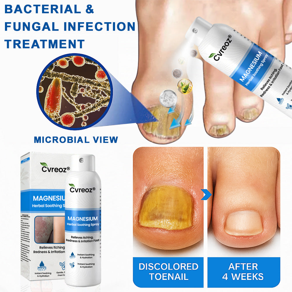 Cvreoz® Magnesium Herbal Psoriasis Spray – Fast, Gentle Relief