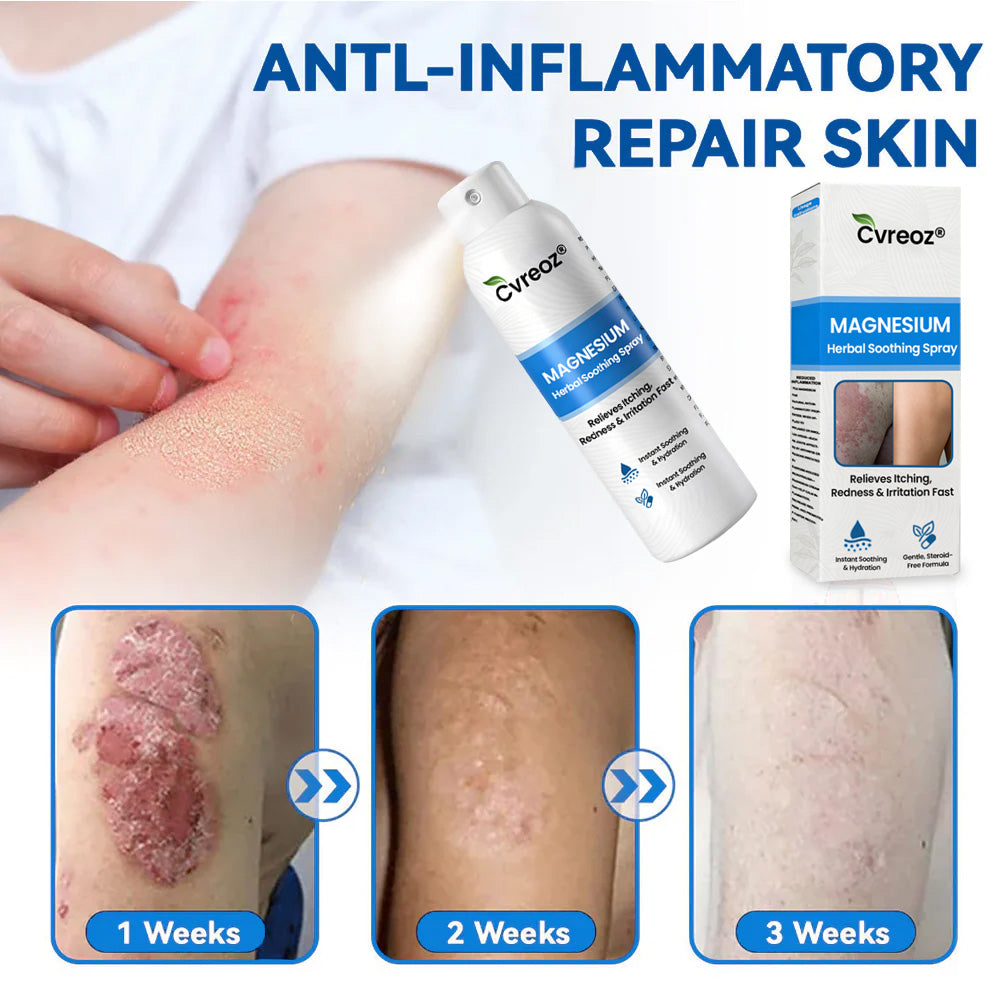 Cvreoz® Magnesium Herbal Psoriasis Spray – Fast, Gentle Relief