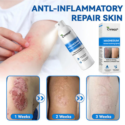 Cvreoz® Magnesium Herbal Psoriasis Spray – Fast, Gentle Relief