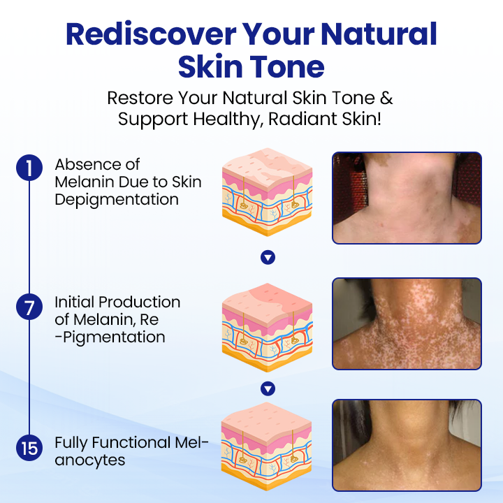 Cvreoz®Vitiligo Treatment Spray