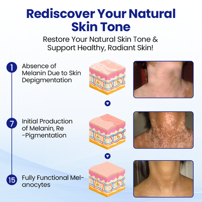 Cvreoz®Vitiligo Treatment Spray