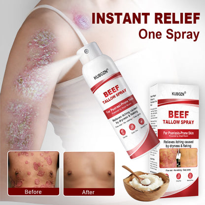 KUBOZN® Beef Tallow Spray for Itchy, Flaky Psoriasis Skin (offer)