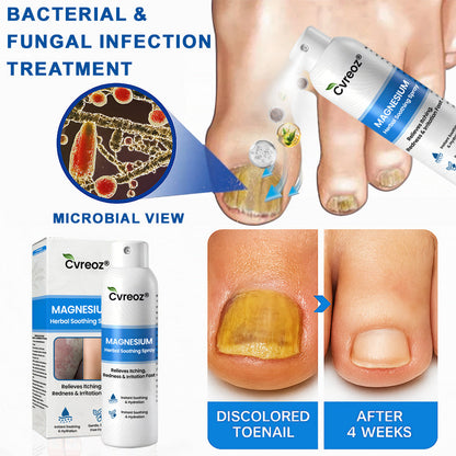 Cvreoz® Magnesium Herbal Psoriasis Spray – Fast, Gentle Relief
