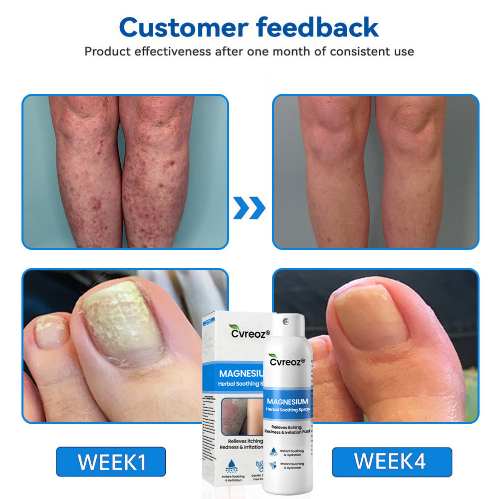 Cvreoz® Magnesium Herbal Psoriasis Spray – Fast, Gentle Relief