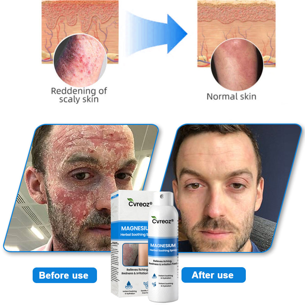Cvreoz® Magnesium Herbal Psoriasis Spray – Fast, Gentle Relief
