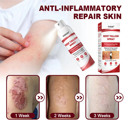 KUBOZN® Beef Tallow Spray for Itchy, Flaky Psoriasis Skin 1
