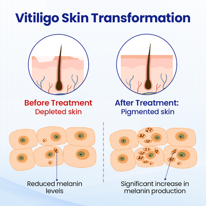 Cvreoz®Vitiligo Treatment Spray