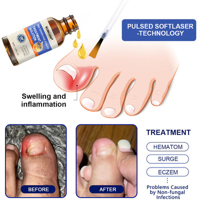 KUBOZN® Bee Venom Nail Fungus Treatment Solution👣