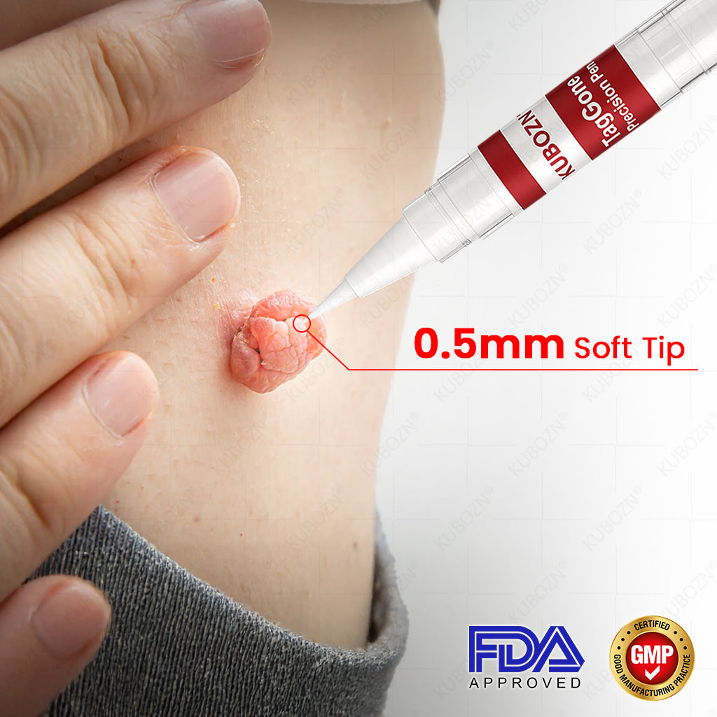 ✨KUBOZN® TagGone Precision Pen (2025 Upgrade) | Skin Tag, Mole & Wart Remover – Fast, Gentle & Scar-Free in 5 Days (offer)