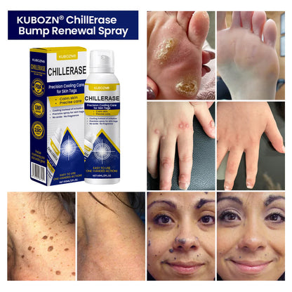 KUBOZN® ChillErase Cooling Spray for Skin Tags